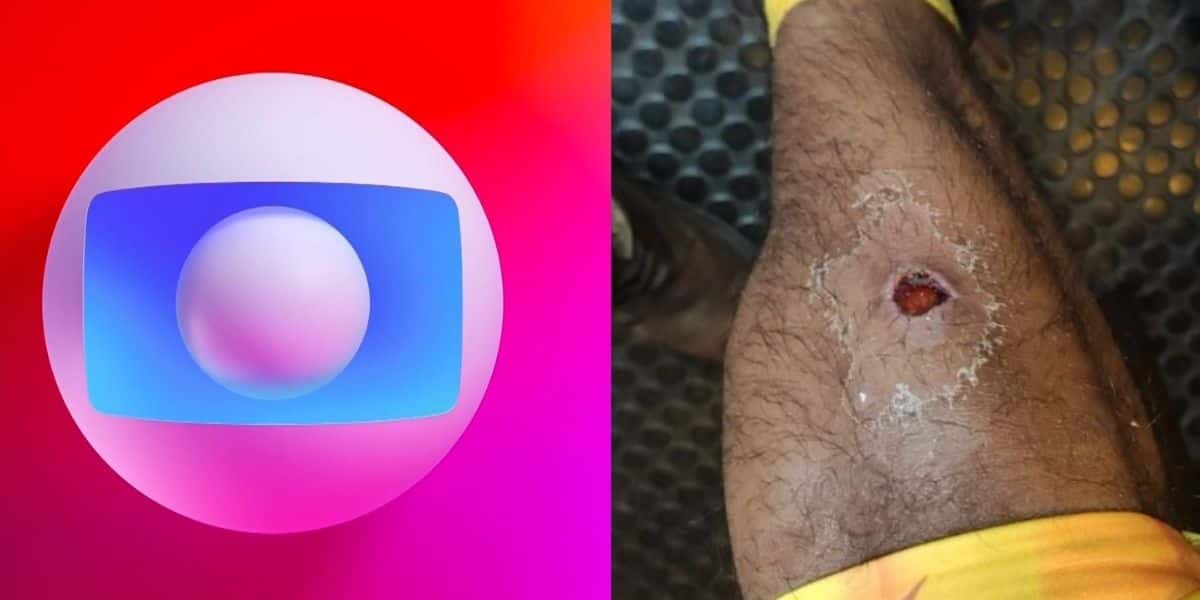 No limite: Famoso da Globo é picado por aranha e quadro é assustador (foto: Reprodução)