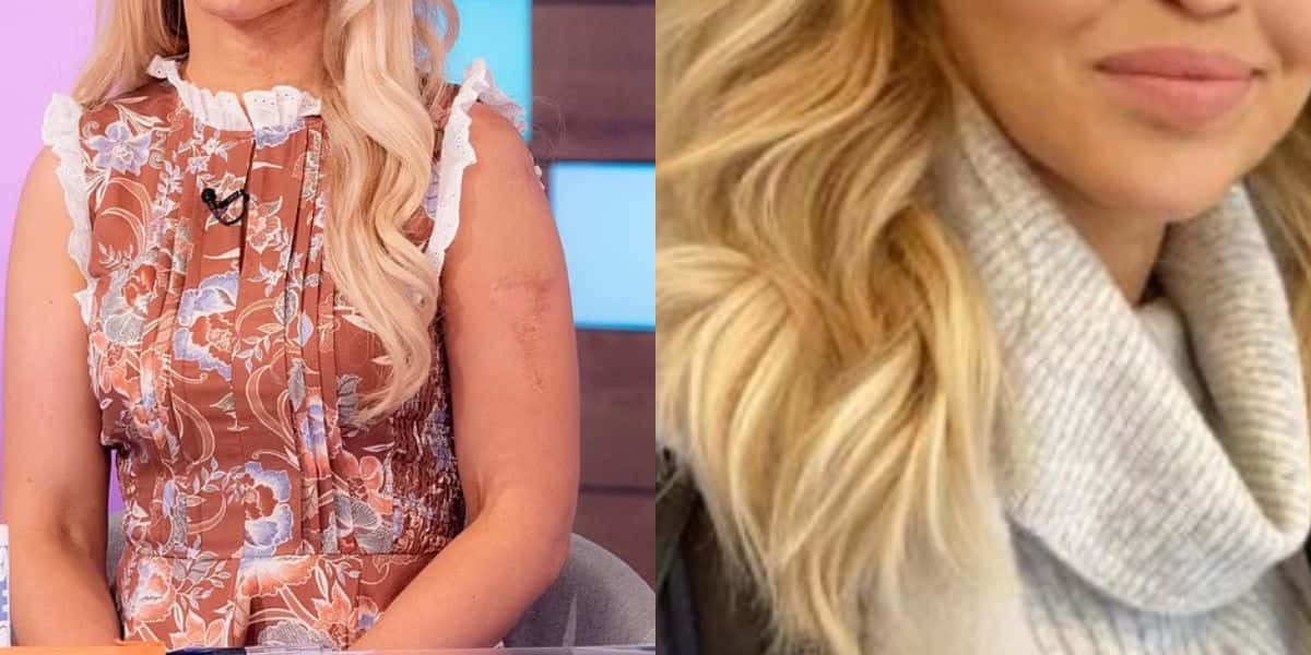 A famosa Katie Piper sofreu um ataque de ácido em 2008
