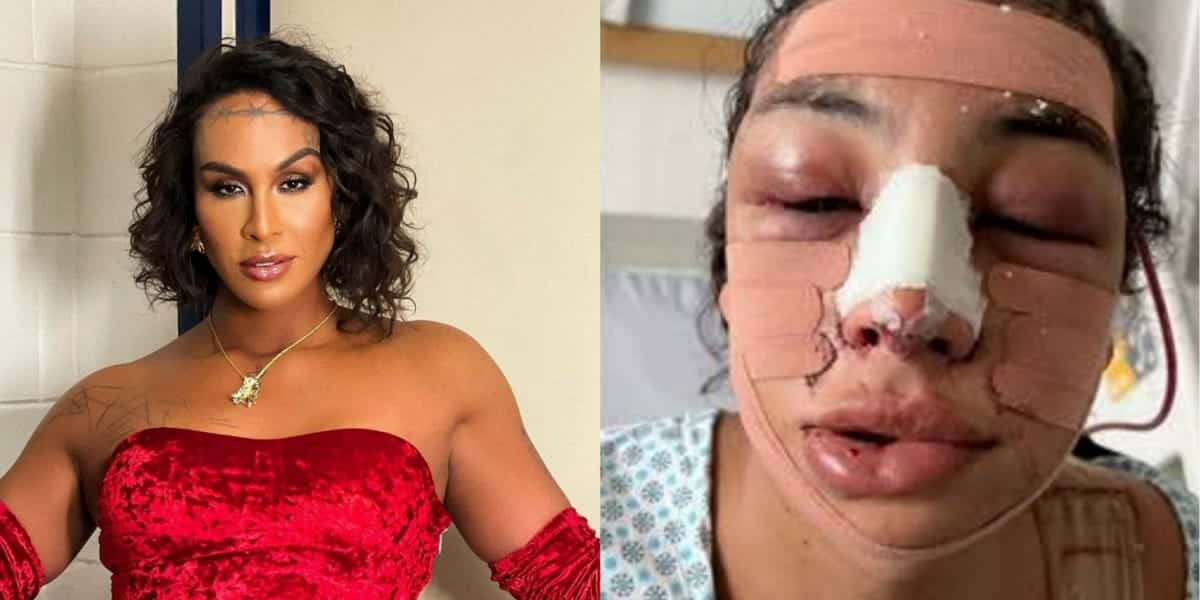 Linn da Quebrada, a Lina,faz cirurgia de feminilização e mostra resultado (Foto: Reprodução / Internet)