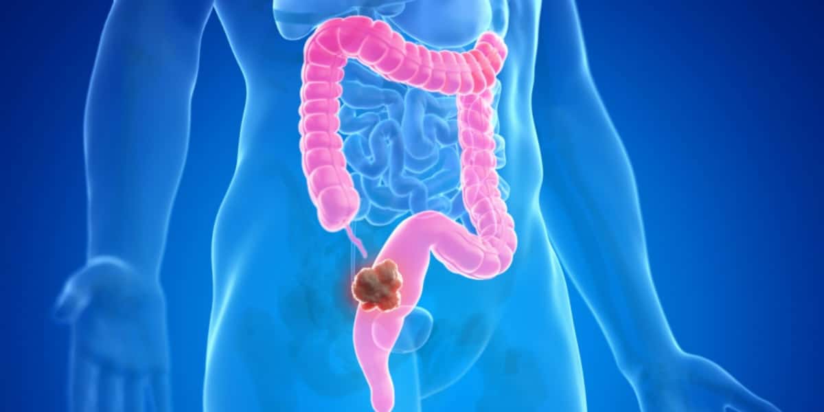 Câncer do intestino é um dos mais comuns do Brasil; conheça os principais sintomas (Foto: Reprodução)