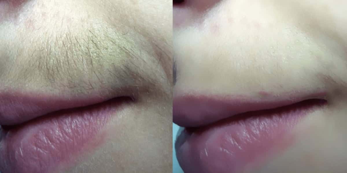 Para acabar com o incomodo do famoso bigodinho (Foto: Reprodução/ Internet)