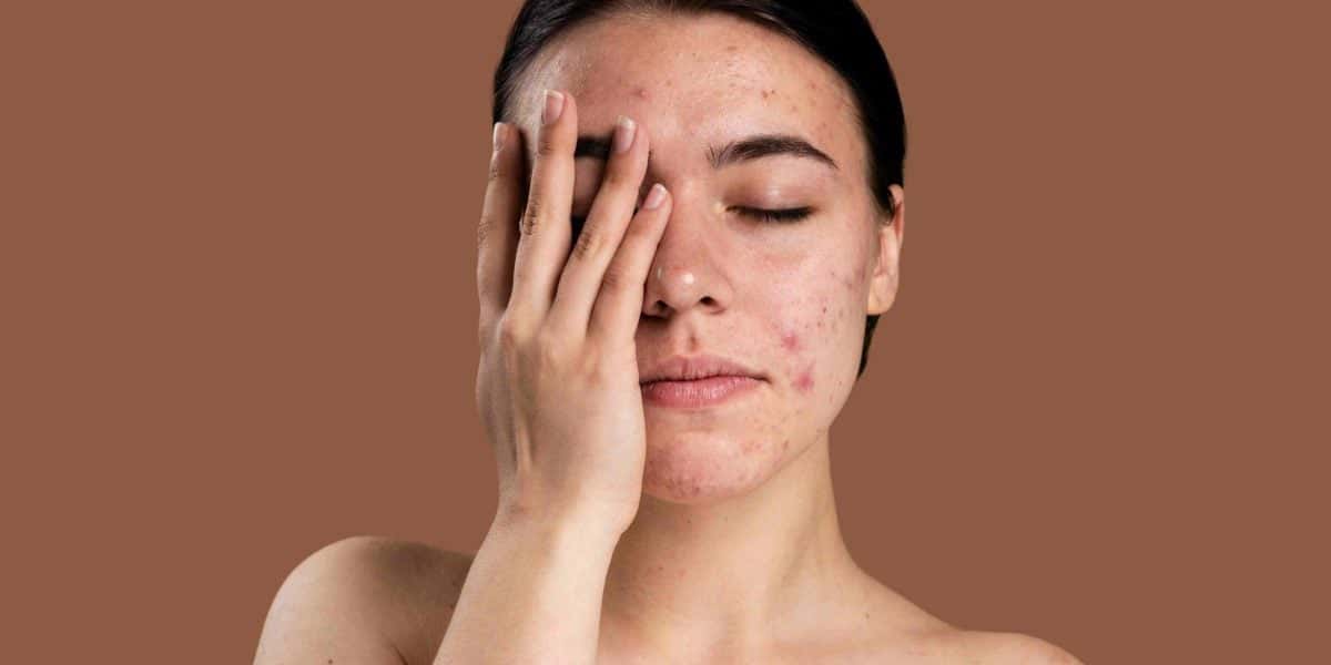 Acnes (Foto: Reprodução/ Internet)