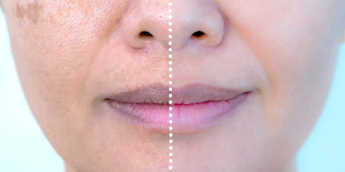 Pele clara e sem manchas com essa receita (Foto: Divulgação)
