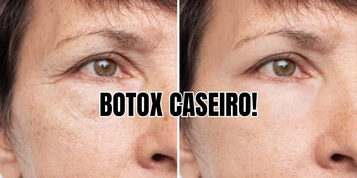 Receitinha de botox caseiro só com 4 ingredientes (Reprodução/Montagem TV Foco)