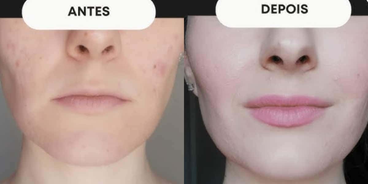 Harmonização facial caseira te livra de rugas e rosto caído (Foto: Divulgação)
