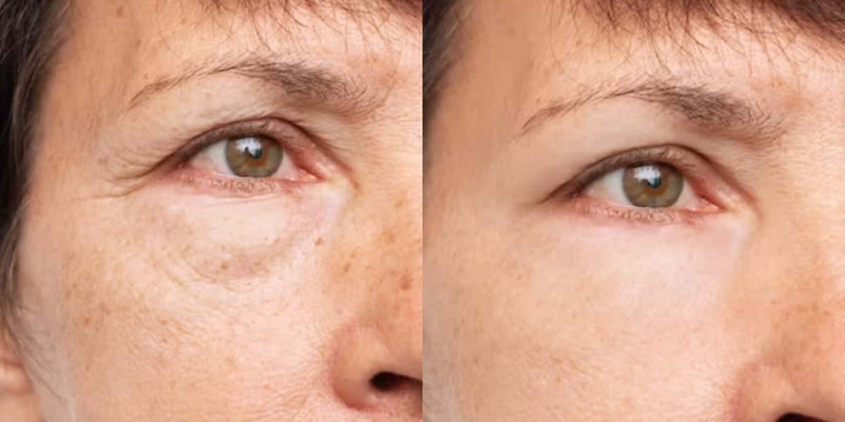 Rugas antes e depois com skincare caseiro (Foto: Divulgação)