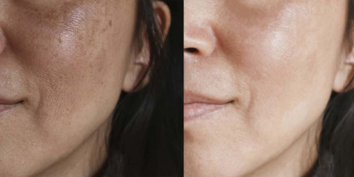Manchas escuras, antes e depois (Reprodução/Internet)