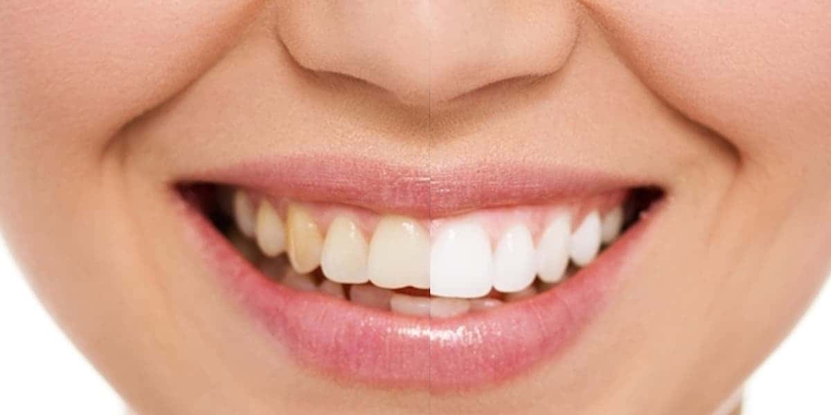 Clareamento caseira para ter dentes branquinhos (Foto: Reprodução - StudioUno)