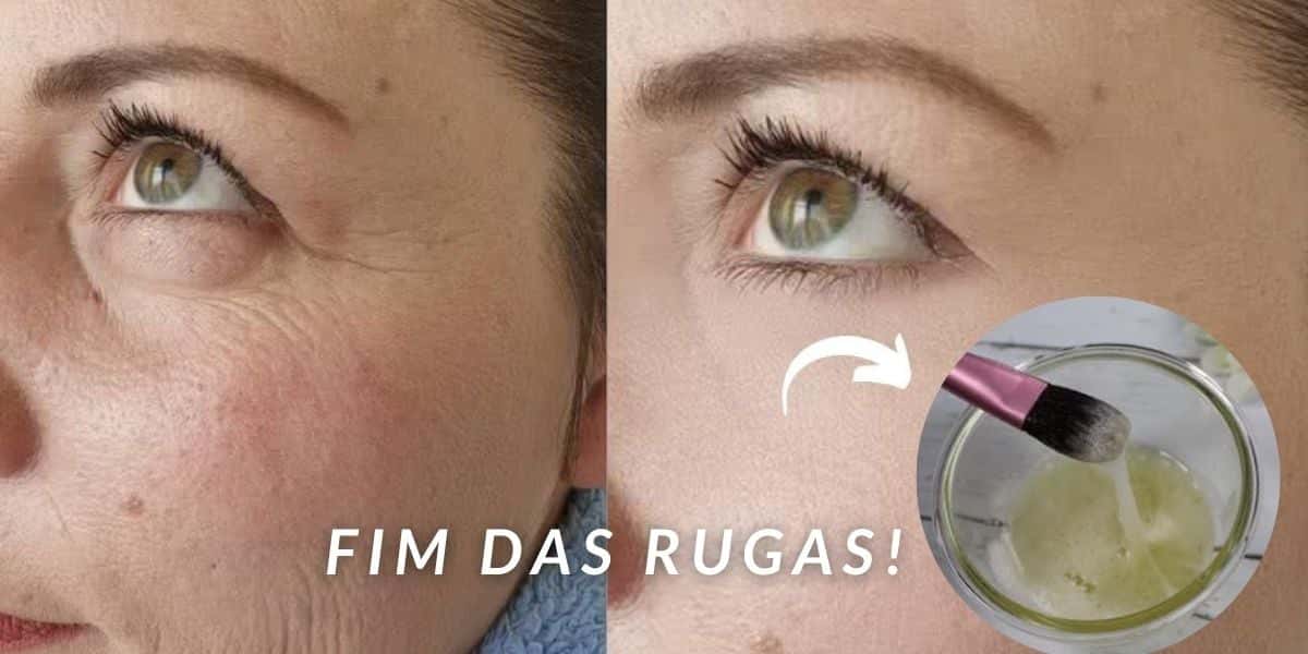 Fim das rugas (Foto: Internet)