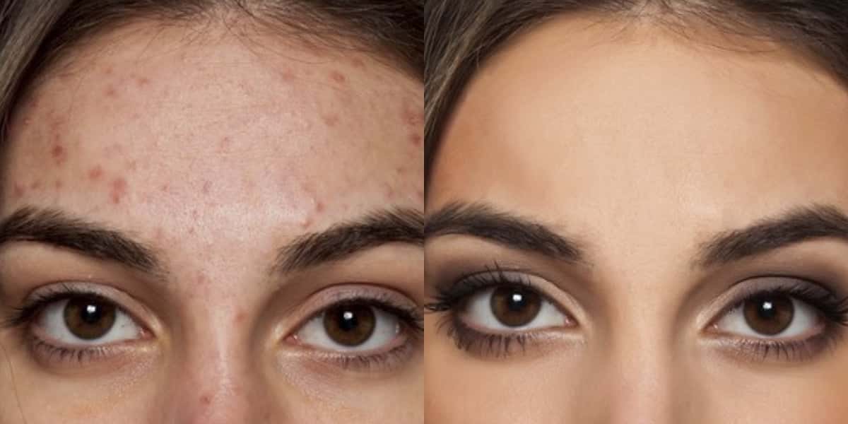 Espinhas e cravos podem melhorar com os chás (Foto: Divulgação)