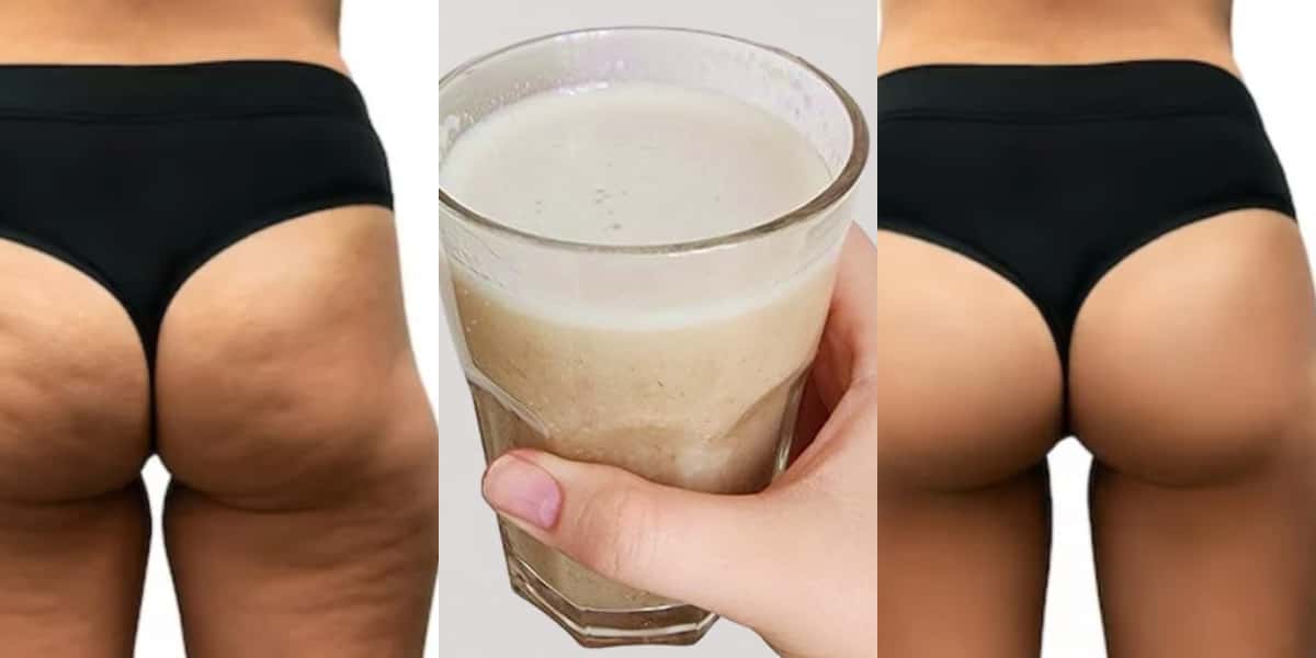 Antes e depois de celulite após usar colágeno caseiro (Foto: Divulgação)