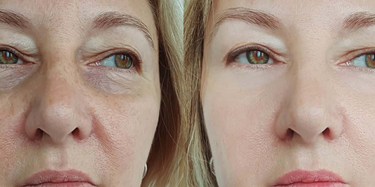 Harmonização 100% natural para rejuvenescer 30 anos (Reprodução: Montagem TV Foco)