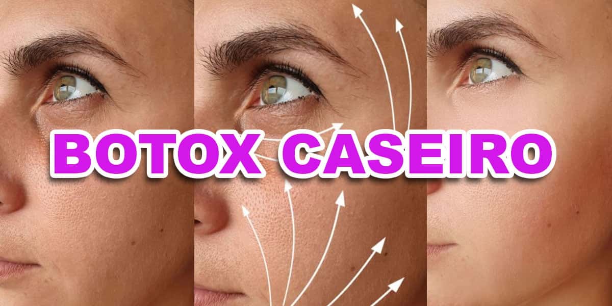 Antes e depois do BOTOX (Foto: Reprodução - Site hamonir)