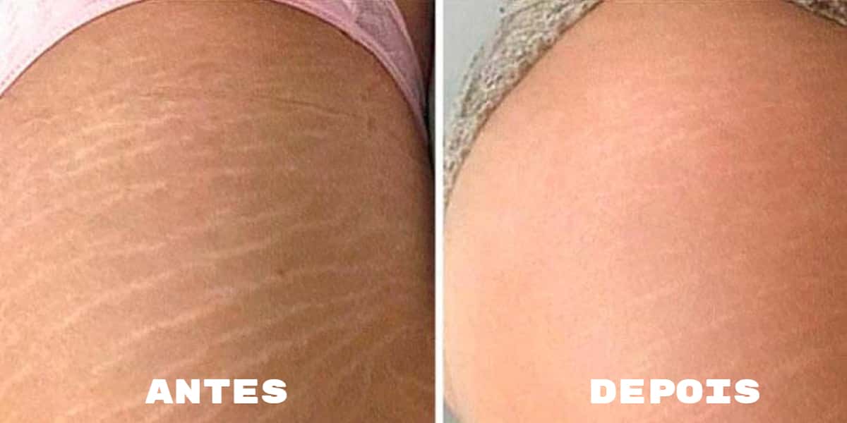 Antes e depois de estrias (Foto: Divulgação)