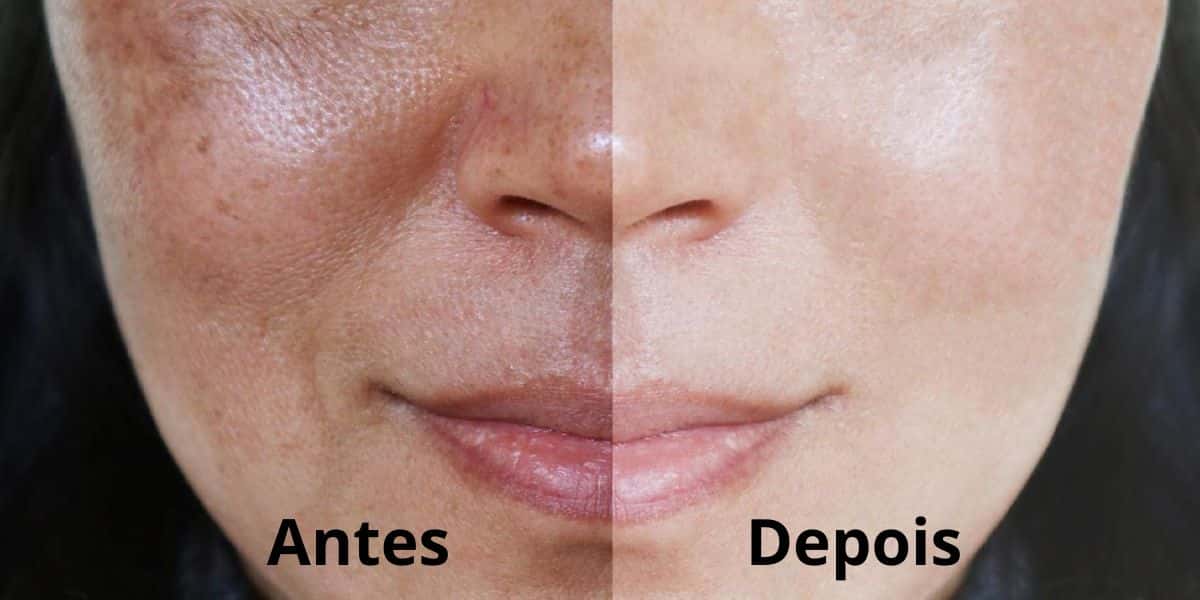 Peeling natural acaba com as manchas de seu rosto (Reprodução: Montagem TV Foco)