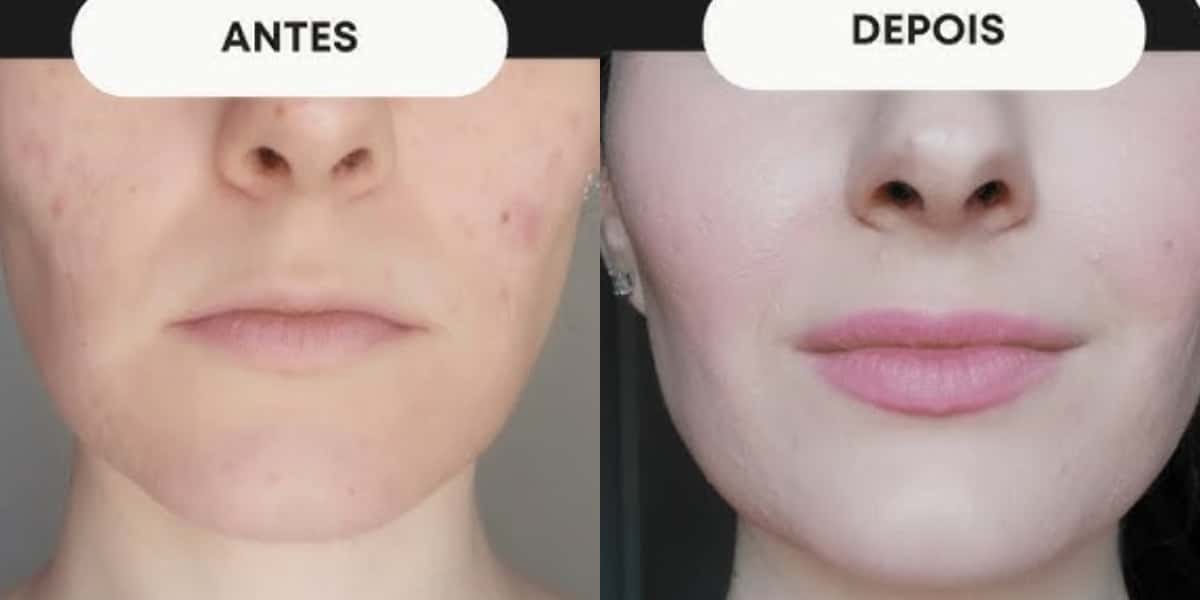 Harmonização facial caseira resultados (Foto: Divulgação)