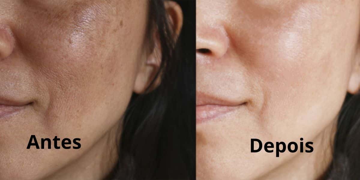 Antes e depois da receitinha de máscara facial (Reprodução: Montagem TV Foco)