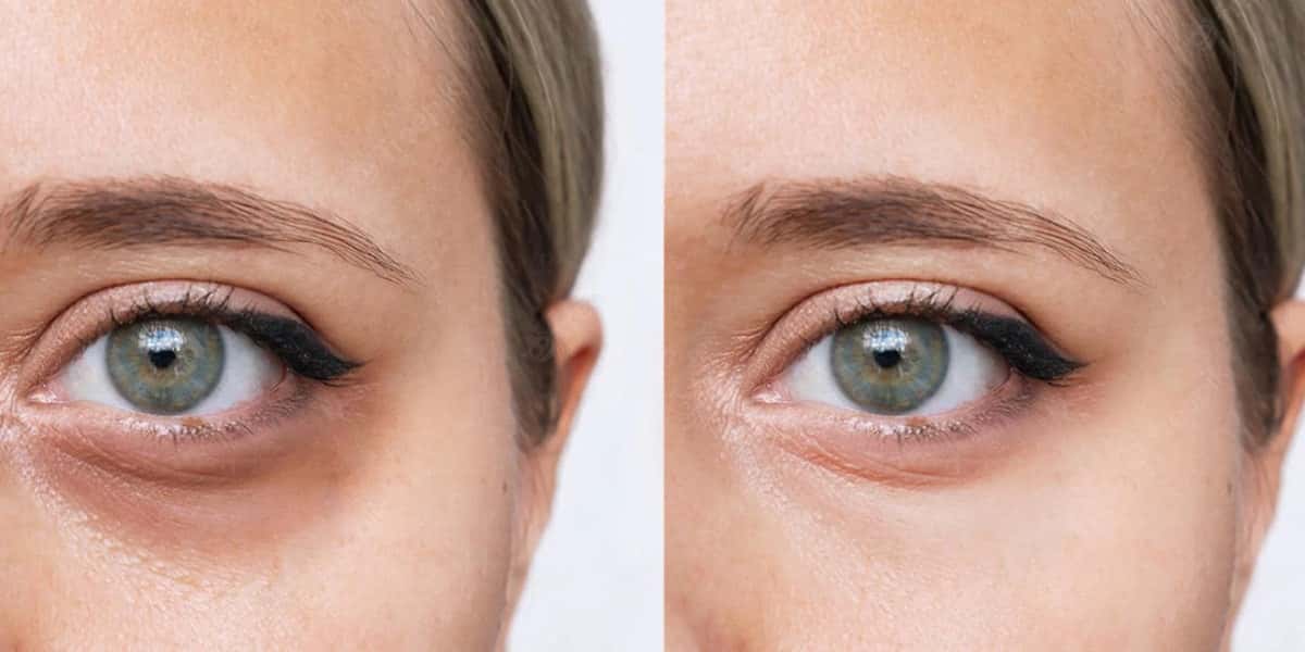 Antes e depois olheiras (Foto: Reprodução - Dr. Iran Sanches)