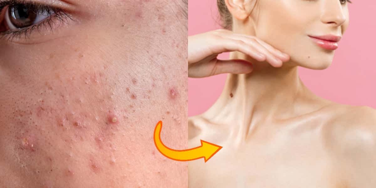 Adeus espinhas e manchas, causadas pela acne, com essa receita (Foto: Montagem)