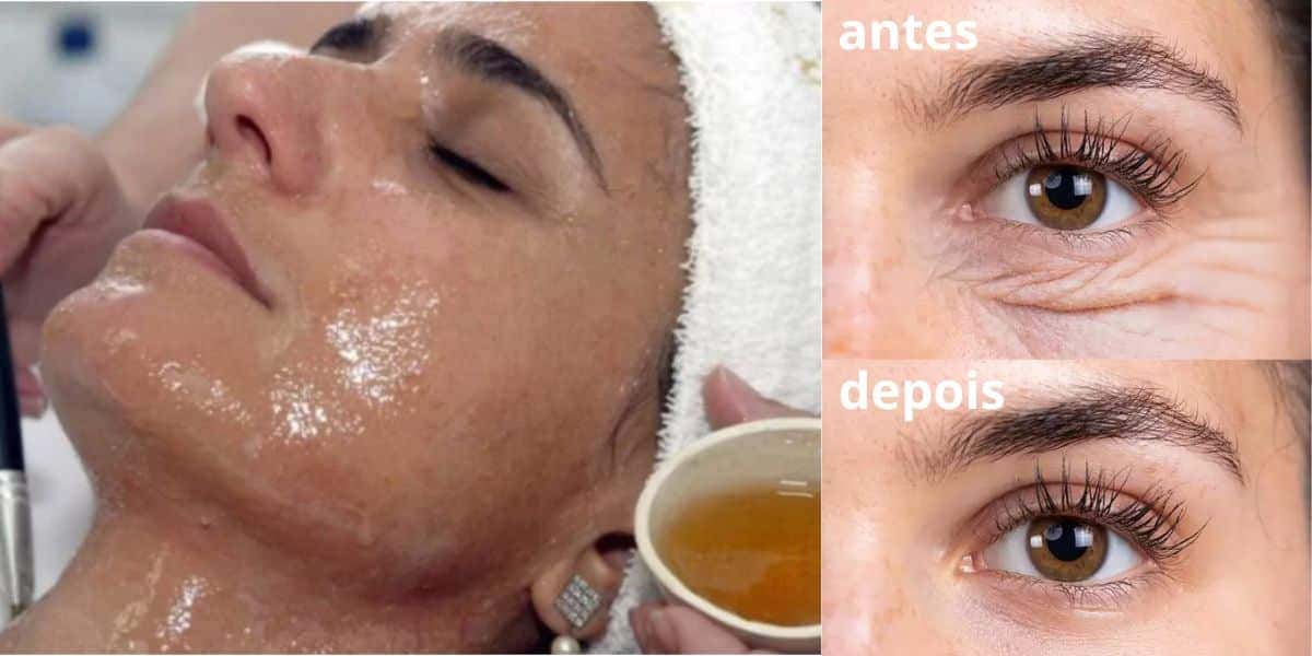 Receitinha caseira com mel trata as rugas e os pés de galinha (Foto: Internet)