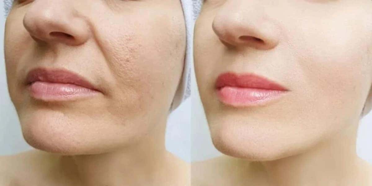 Harmonização facial caseira - Foto: Internet