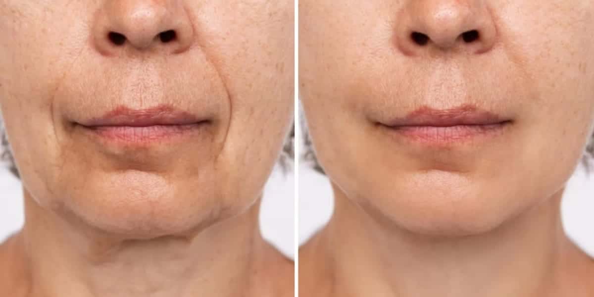 Harmonização facial caseira - (Foto: Internet)