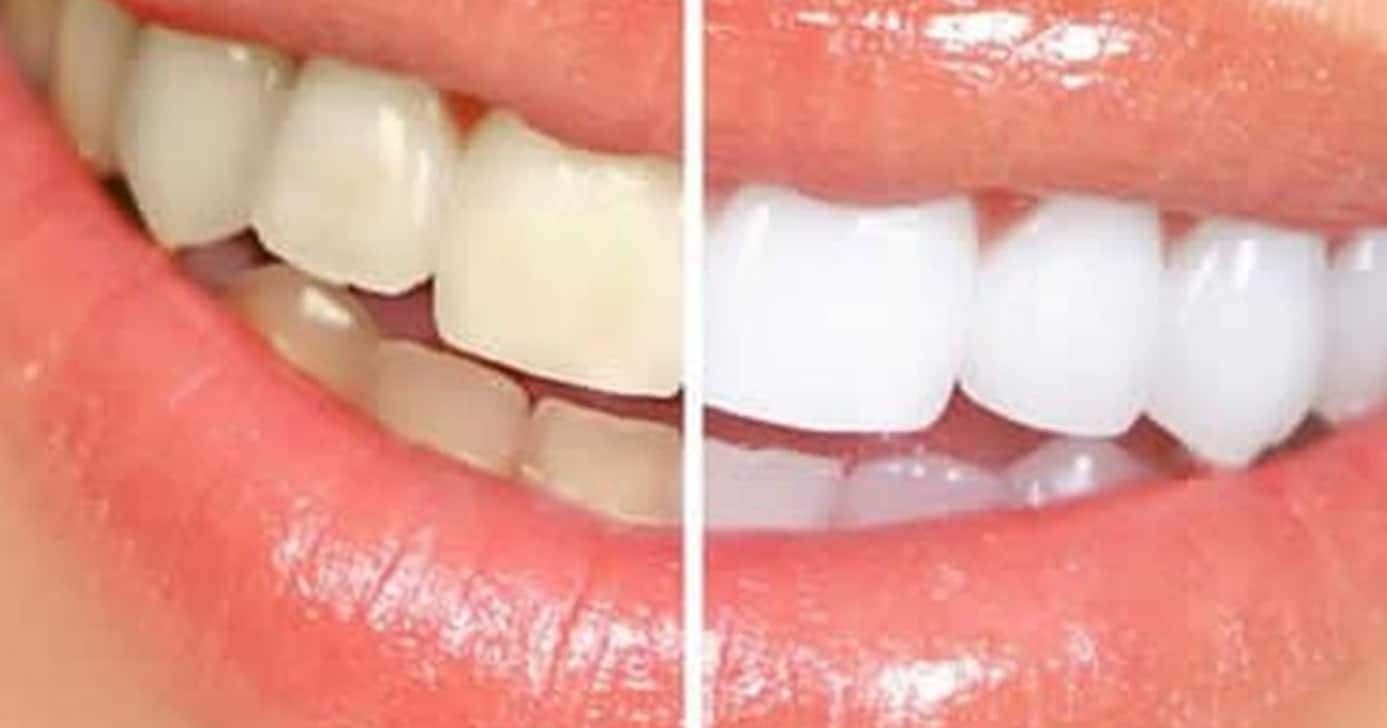 Dentes brancos com esses passos - (Foto: Montagem)
