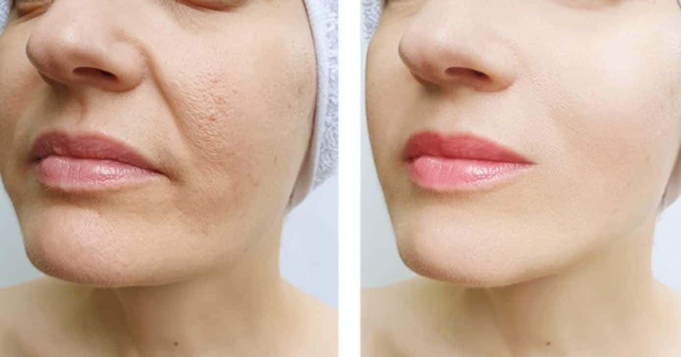 Receita com 2 ingredientes elimina o bigode chinês em definitivo (Reprodução/Canva/Clinica Flávia Freitas)