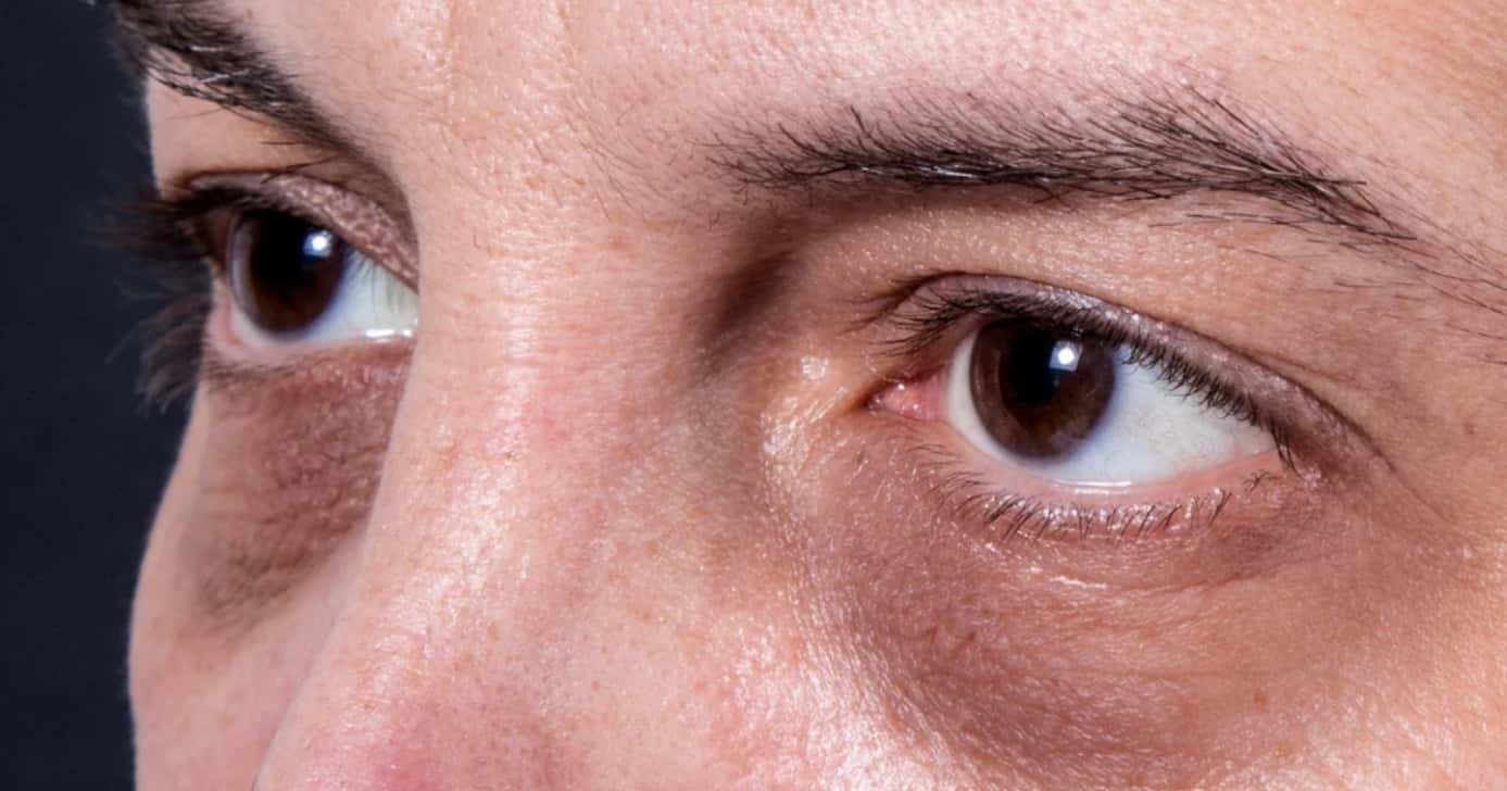 Manchas ao redor dos olhos sinalizam condição perigosíssima de saúde - Foto: Internet