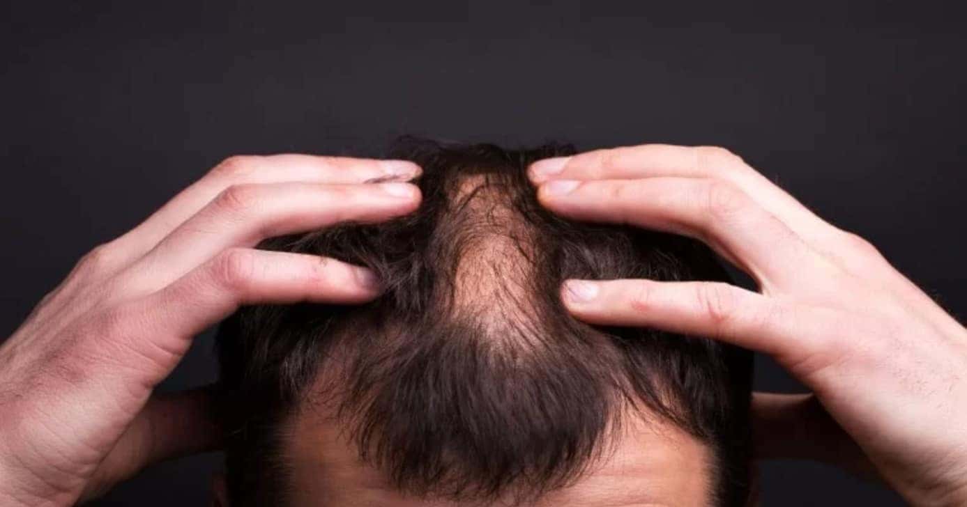 2 remédios naturais acabam com a queda de cabelo dos homens - (Foto: Internet)