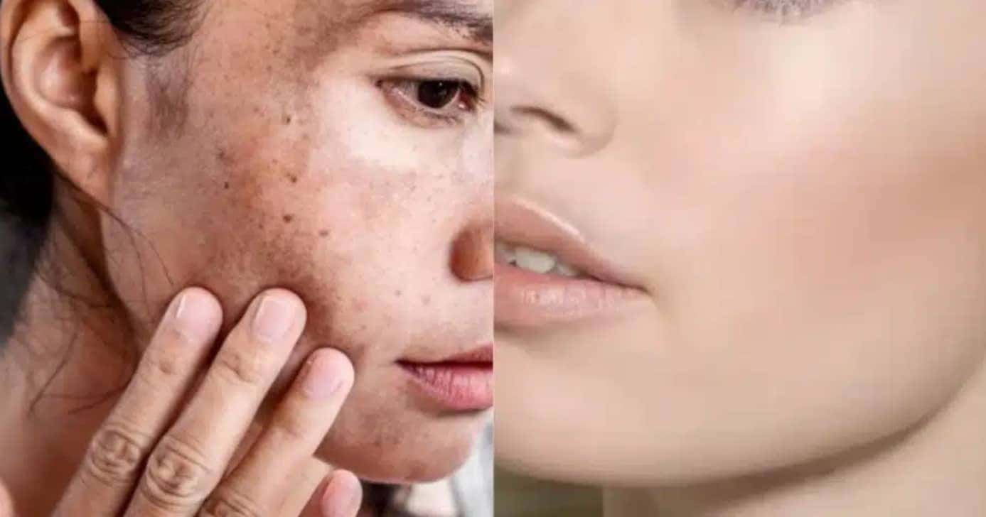 Milagre da juventude: Mistura natural com 2 ingredientes some com rugas e deixa pele lisinha igual ao botox - Foto: Internet