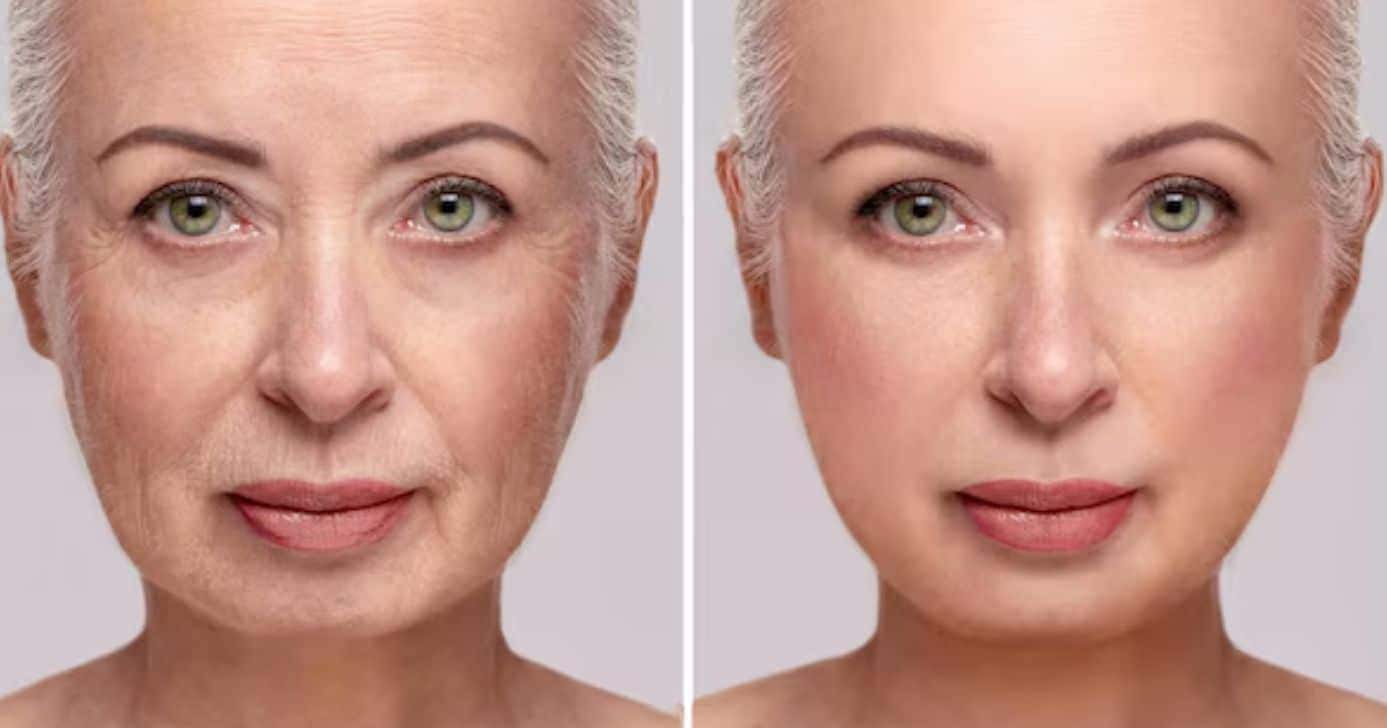 Mulher com e sem rugas (Foto: Freepik)