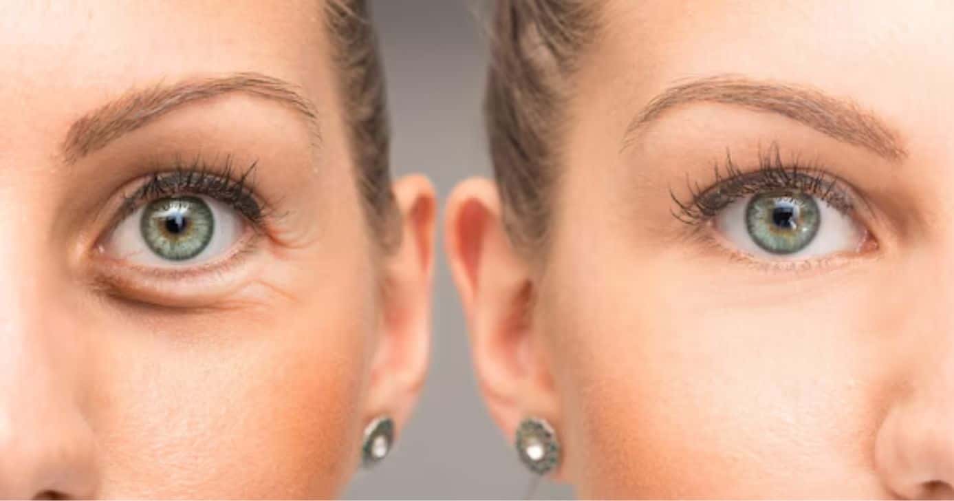 Antes e depois de olheiras (Foto: Freepik)