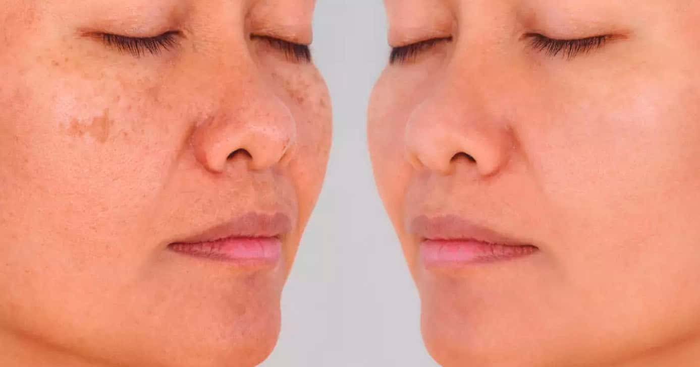 Manchas no rosto - Antes e depois (Foto: Reprodução)