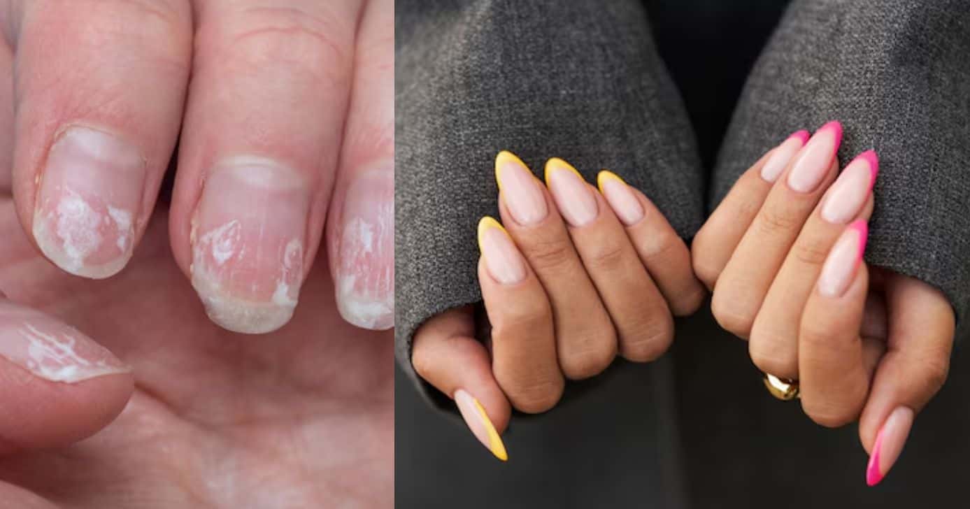 Unhas quebradas e grandes (Fotos: Freepik)