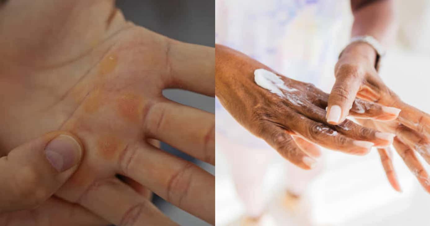 Mistura com 4 ingredientes elimina ressecamento e calos (Foto: Reprodução/Montagem TV Foco)