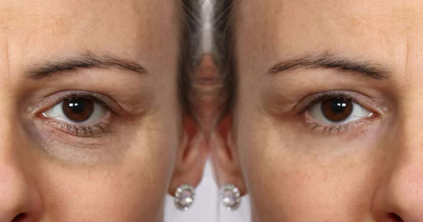 Antes e depois de olheiras (Fotos: Freepik)
