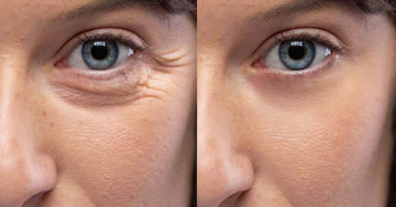 Antes e depois de olheiras (Foto: Freepik)