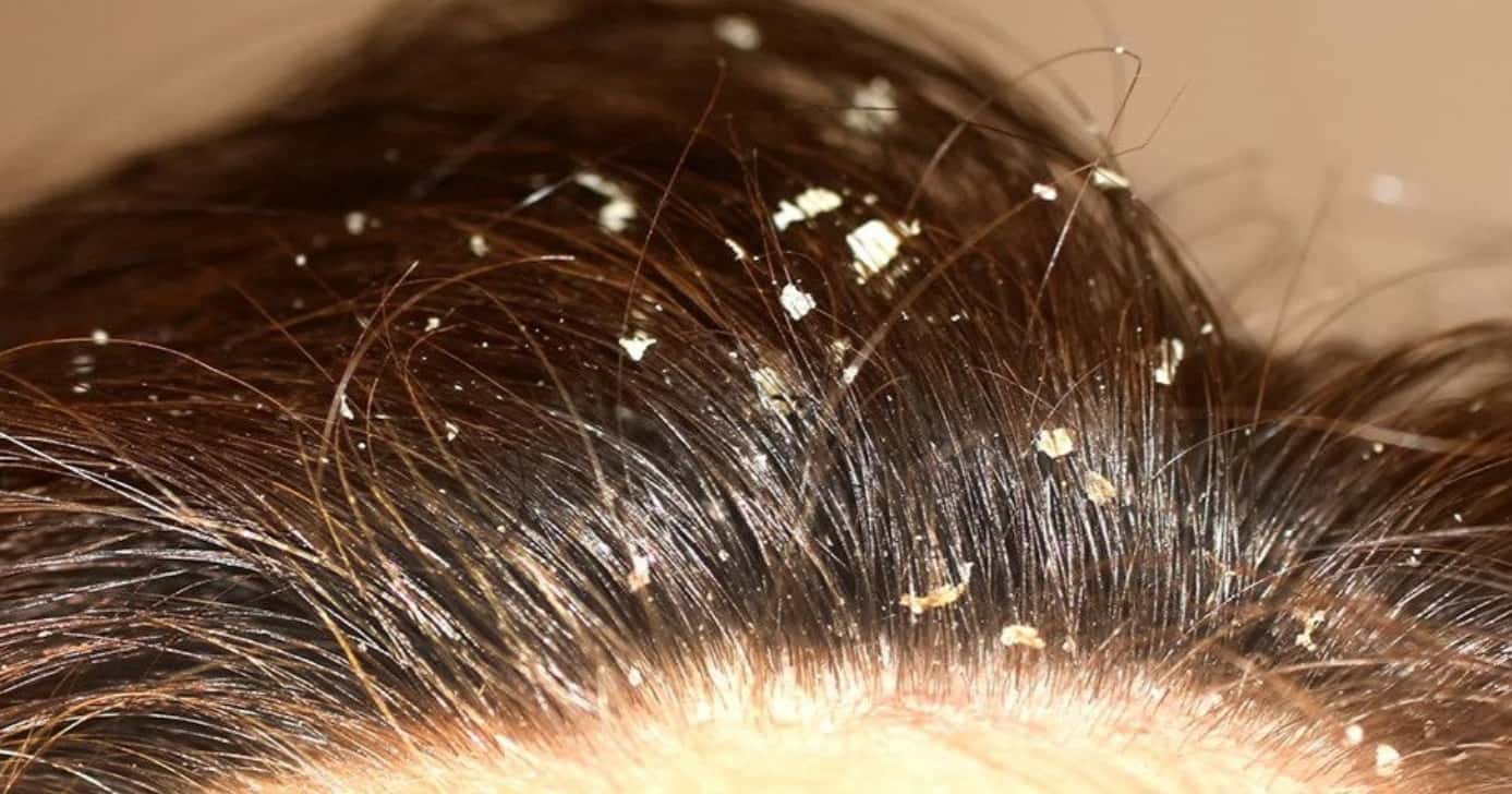 Truques para acabar com a caspa (Foto: Divulgação)