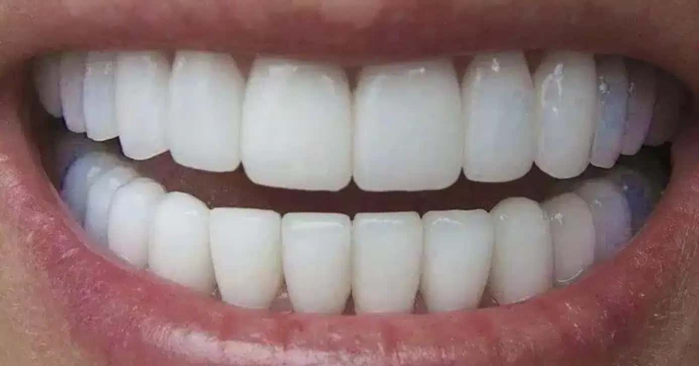 Dentes brancos - (Foto: Reprodução/ Internet)