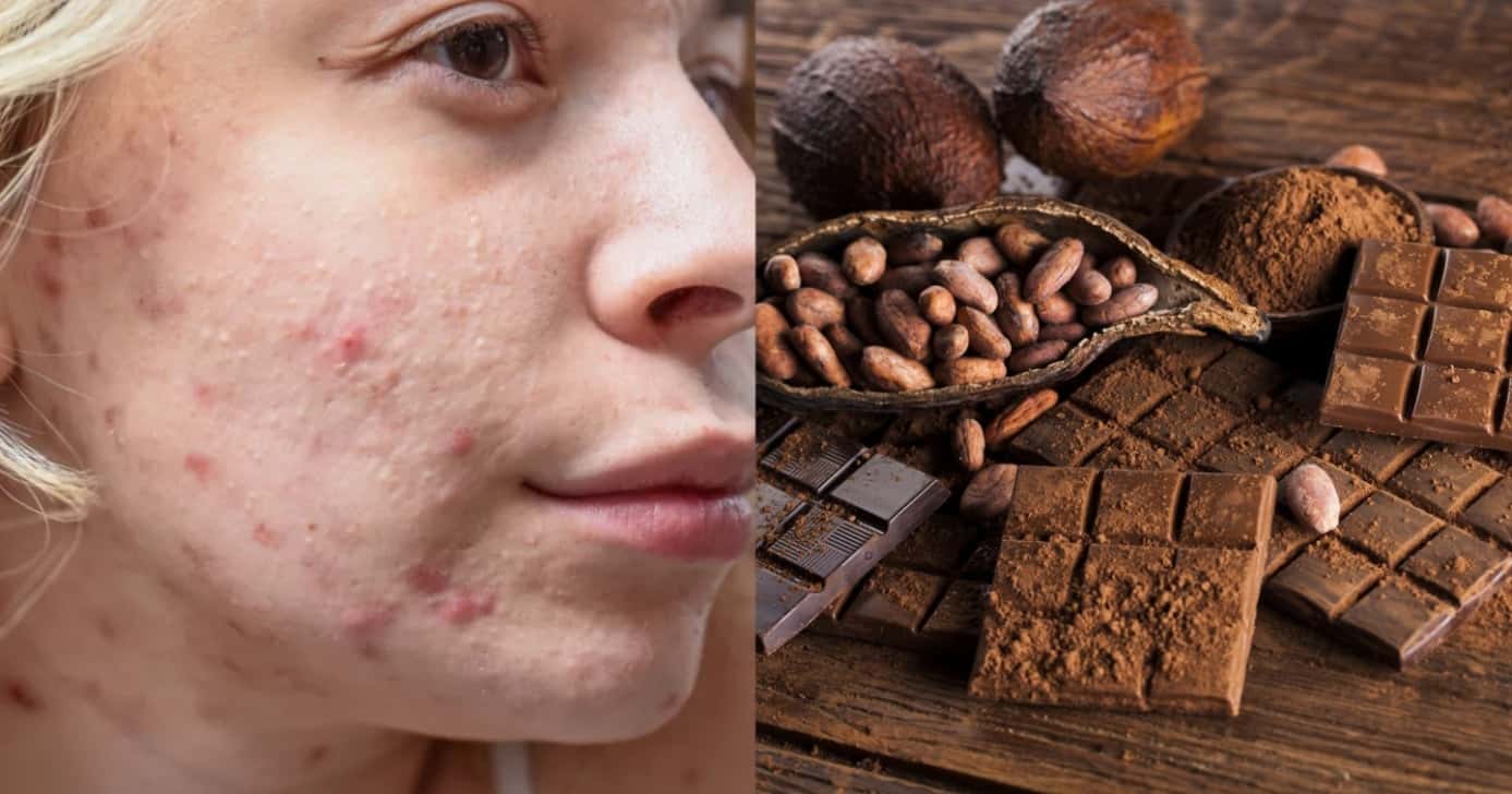 Consumir chocolate pode causar mais espinhas - Foto: Montagem