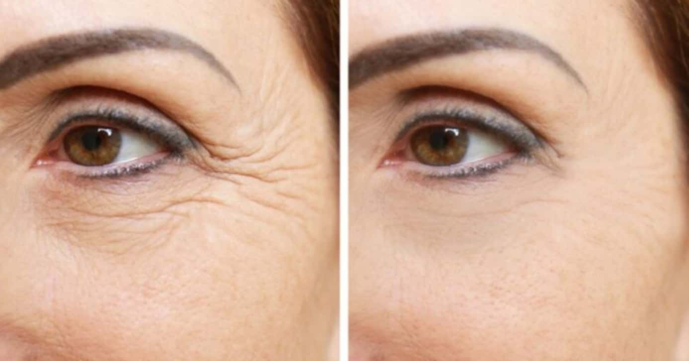 Botox caseiro para dar fim das rugas - Foto: Internet