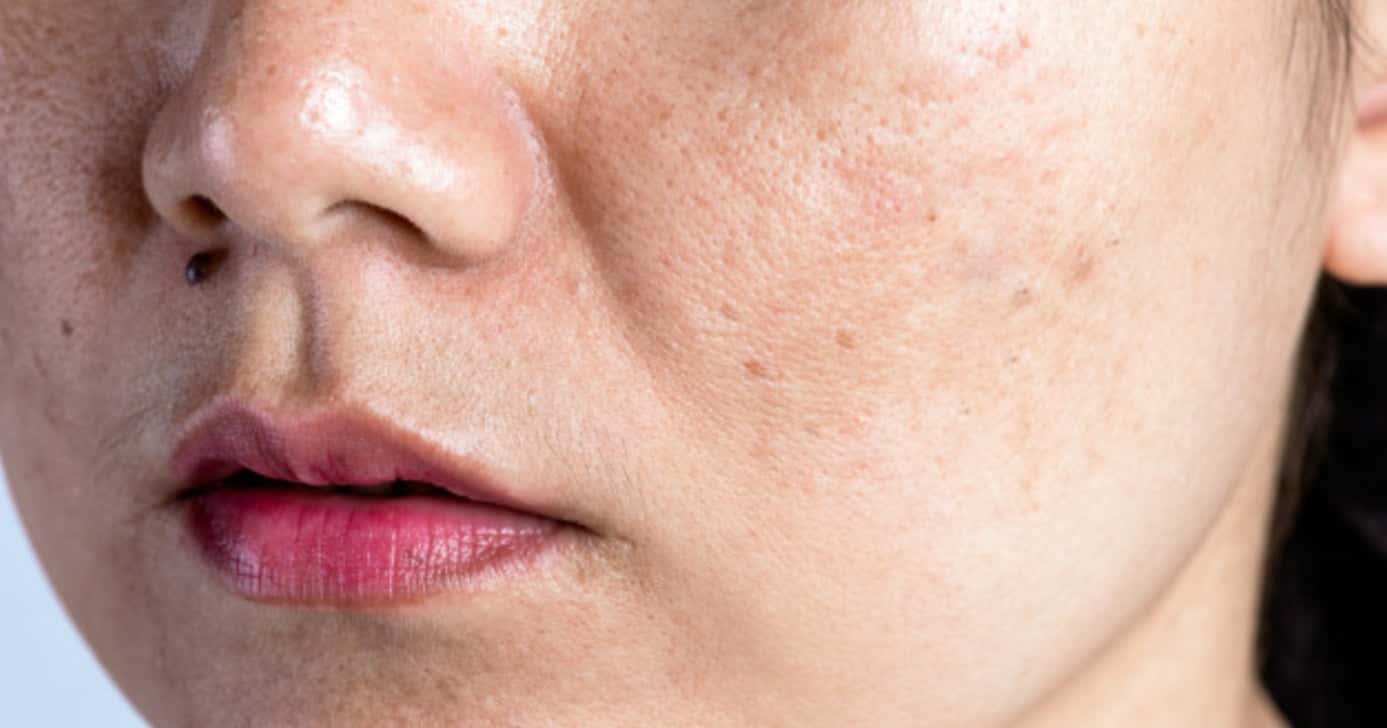 Misturinha com 3 ingredientes traz botox natural e fim das rugas - Foto: Internet