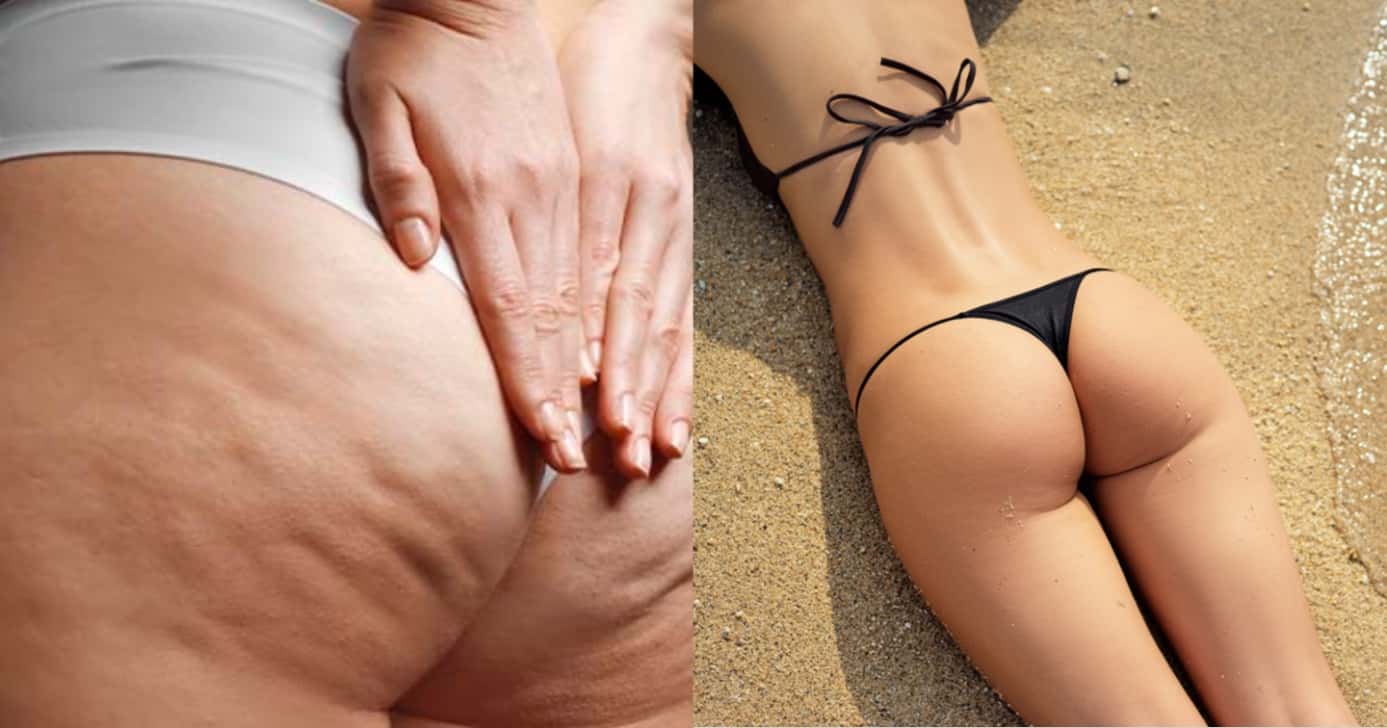 Adeus, celulite: 3 produtos de farmácia que deixam pernas lisinhas para o Verão - Montagem/TV FOCO