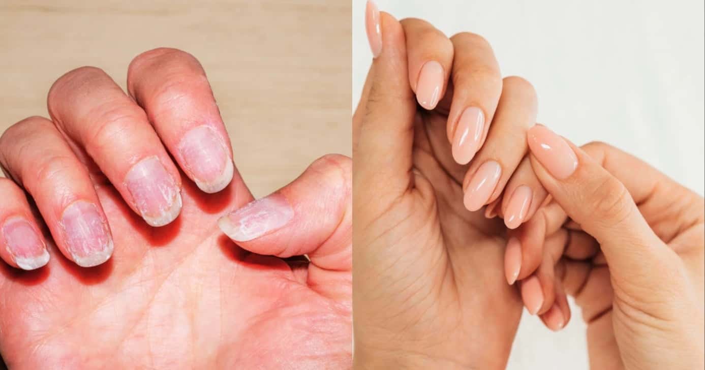 Unhas fracas e quebradiças e unhas fortes e saudáveis (Foto: Reprodução/ Internet)