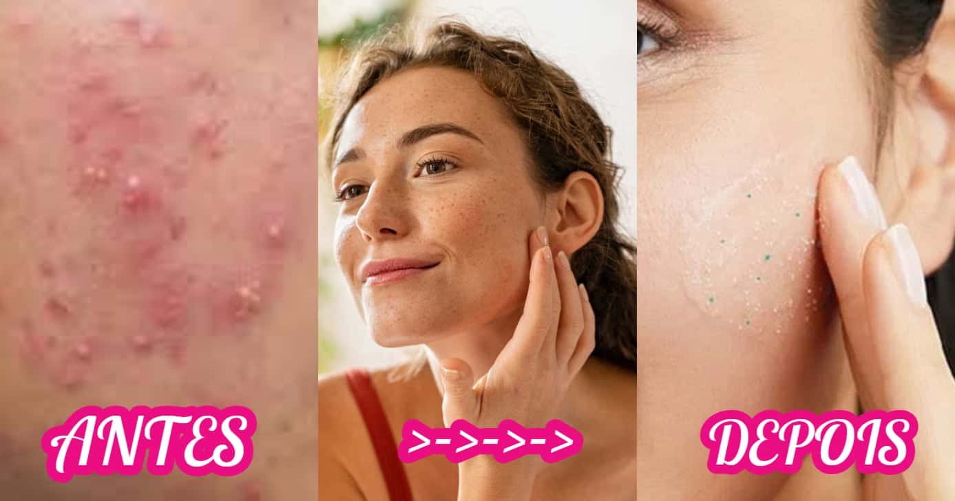 Essas são as cinco dicas que ajudam a evitar o surgimento de espinhas (Foto: Divulgação)