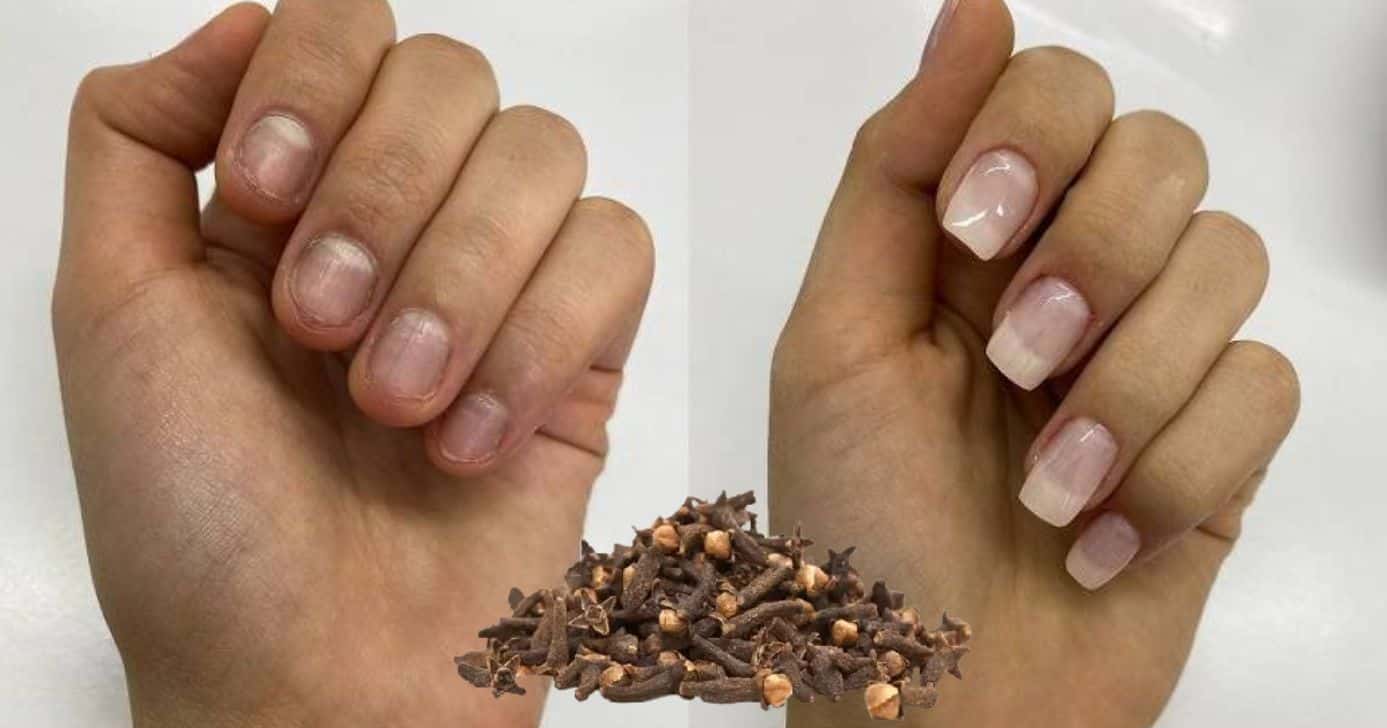 Como fazer solução caseira com cravo para ter unhas fortes e longas e se livrar do gasto no salão (Foto Reprodução/Montagem/TV Foco/Canva/Paola)