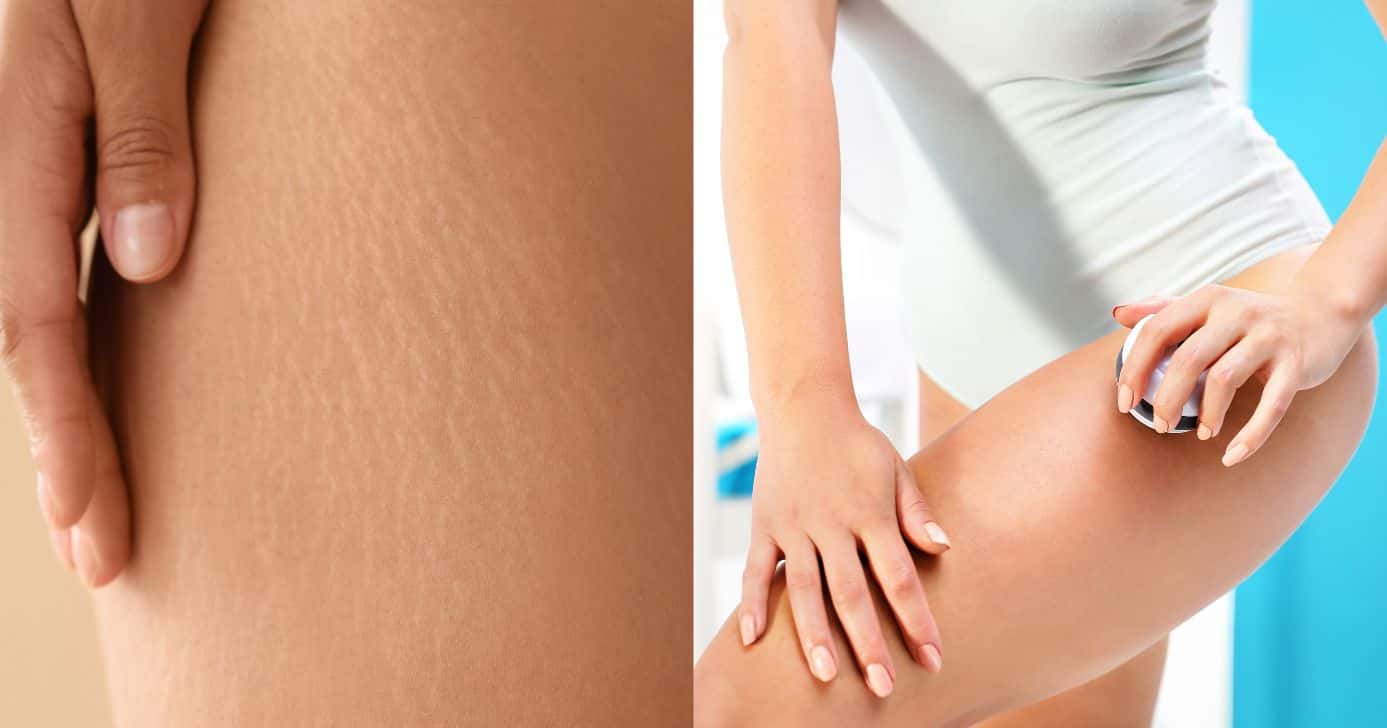 Ilustração antes e depois de celulite (Fotos: Canva)