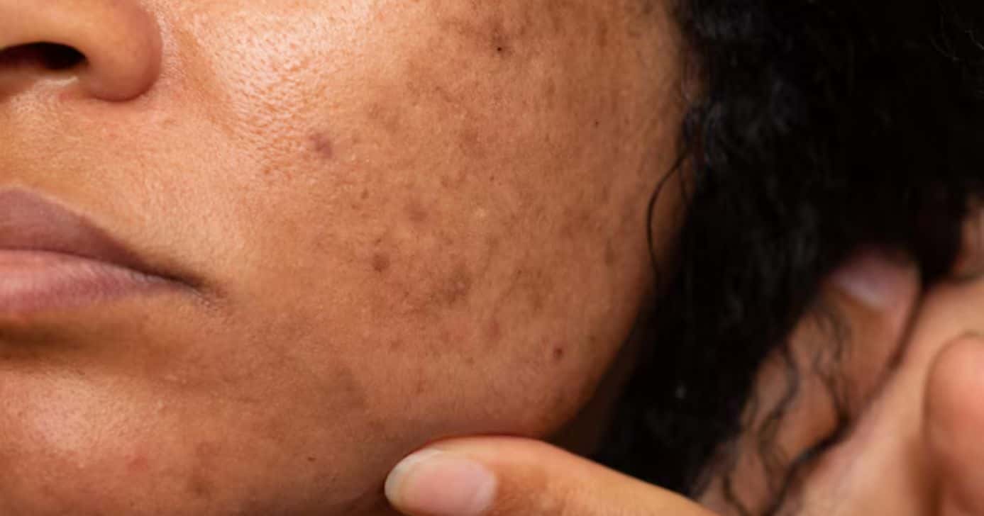 7 erros no cuidado com o melasma (Foto: Reprodução/ Internet)