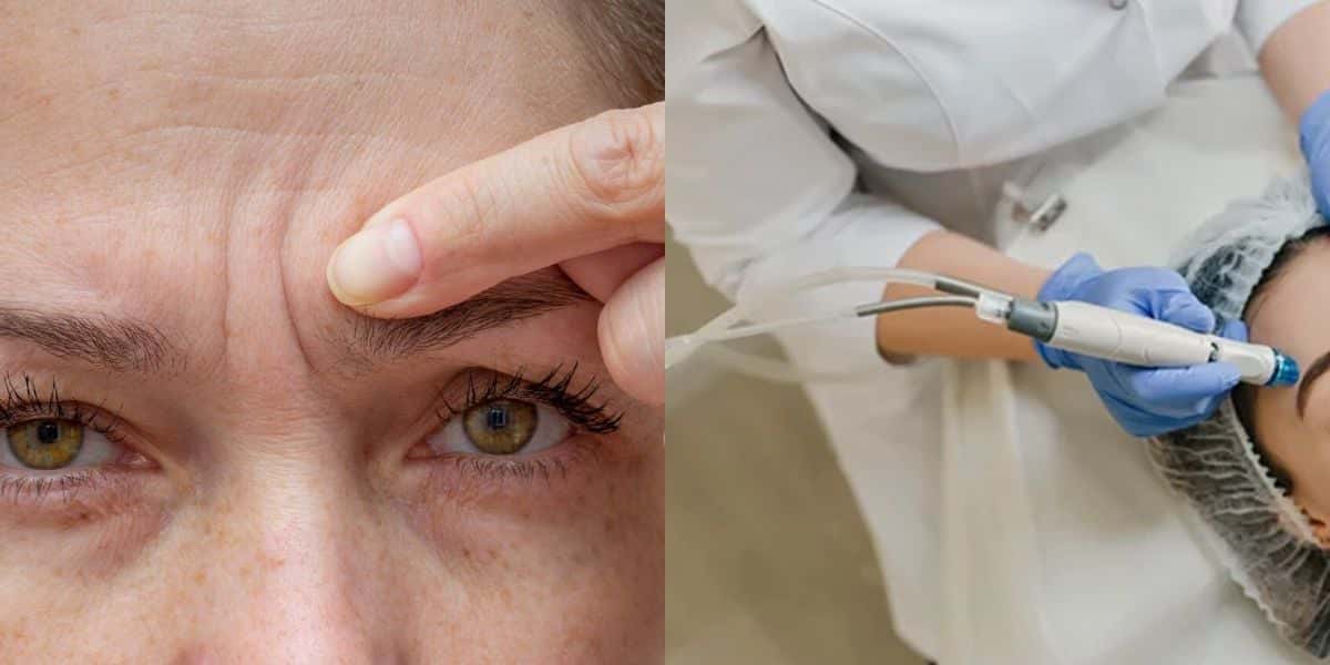 Dermatologista diz como amenizar rugas entre sobrancelhas (Reprodução: Montagem TV Foco)